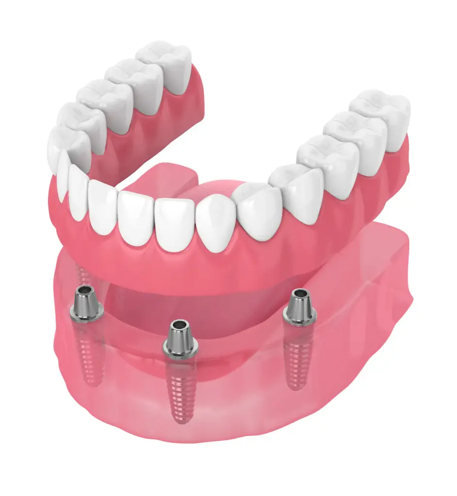 Implant secured dentures